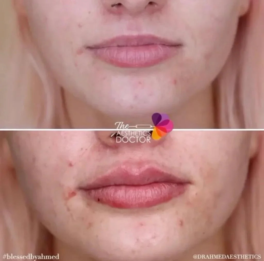 Exploring The Benefits Of Lip Filler Dissolving Treatment