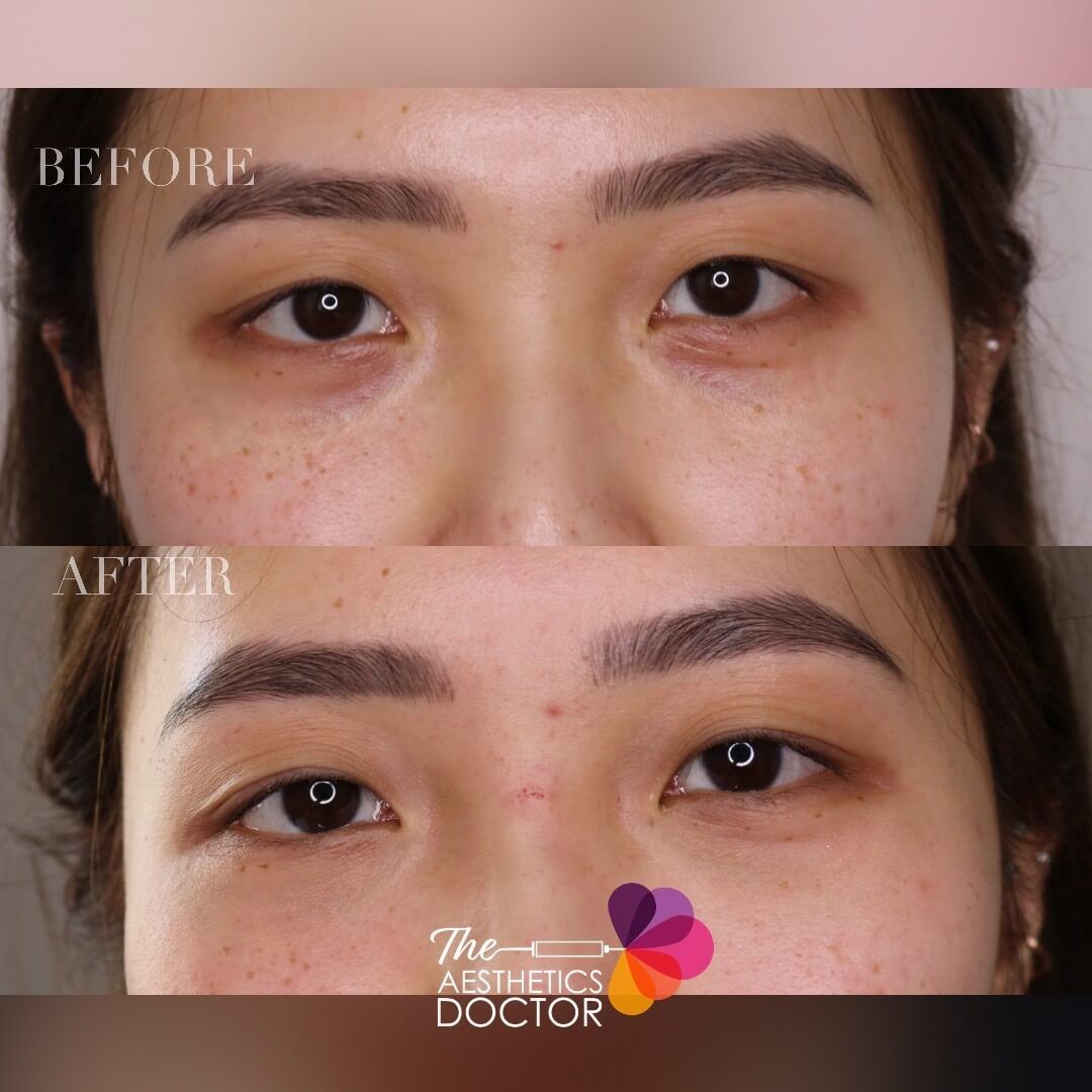 Tear Trough Fillers for Asian Patients