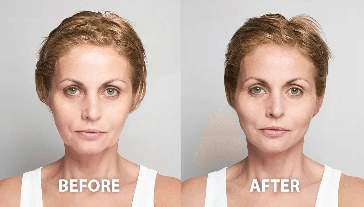 Non-Surgical Face Thread Lift And Brow Lift: Q & A
