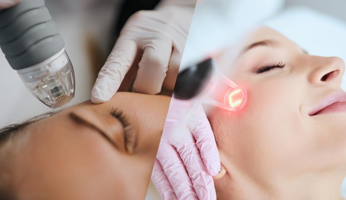 Laser vs Microneedling: Which Stimulates More Collagen?