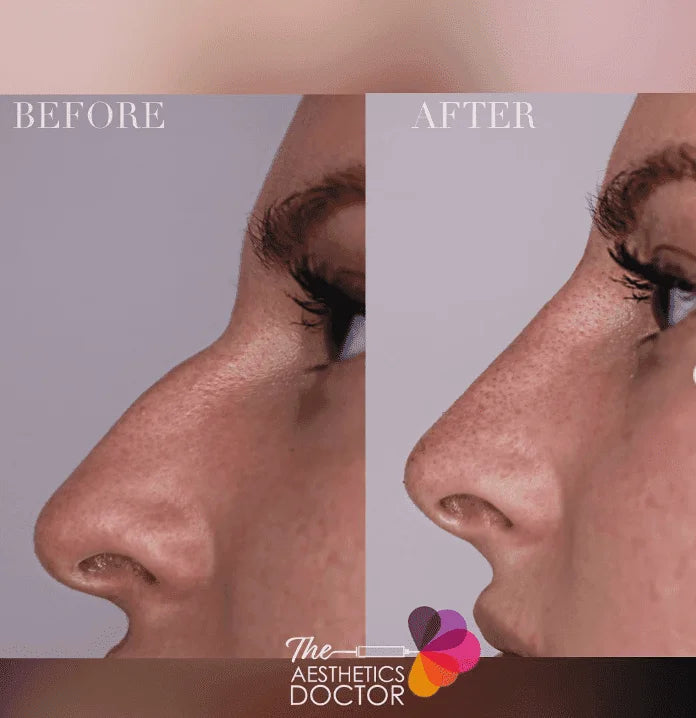 Can I Have a Non-Surgical Nose Job After Rhinoplasty?