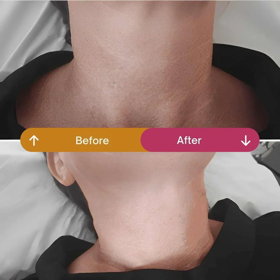 Skin Boosters vs Profhilo: Which Treatment Is Best?