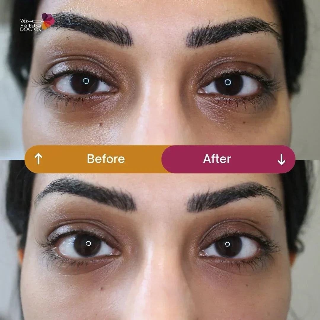 Botched tear trough filler - Tear Trough Filler Gone Wrong? We Can Fix It