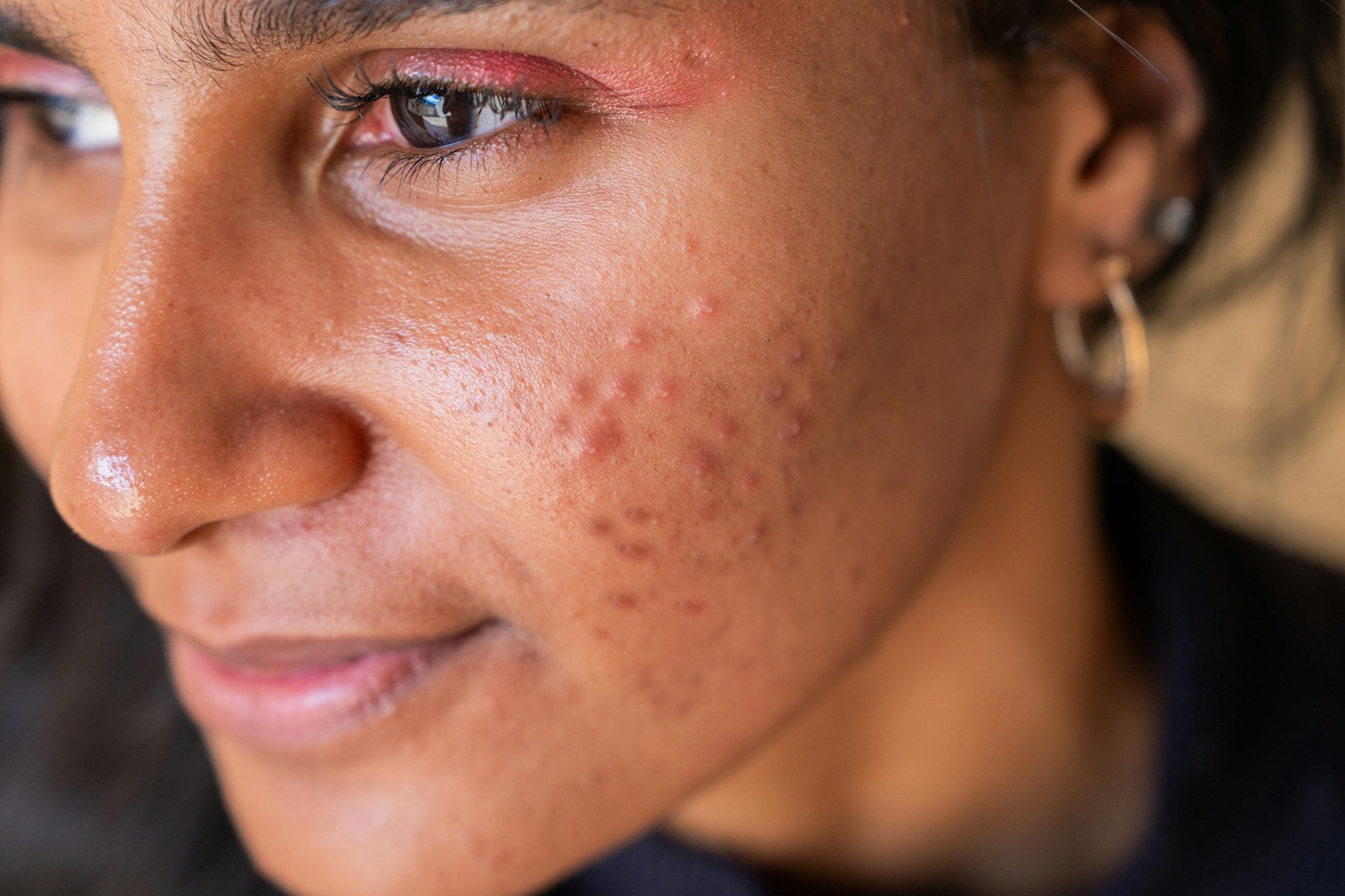Acne Congested Skin Concern