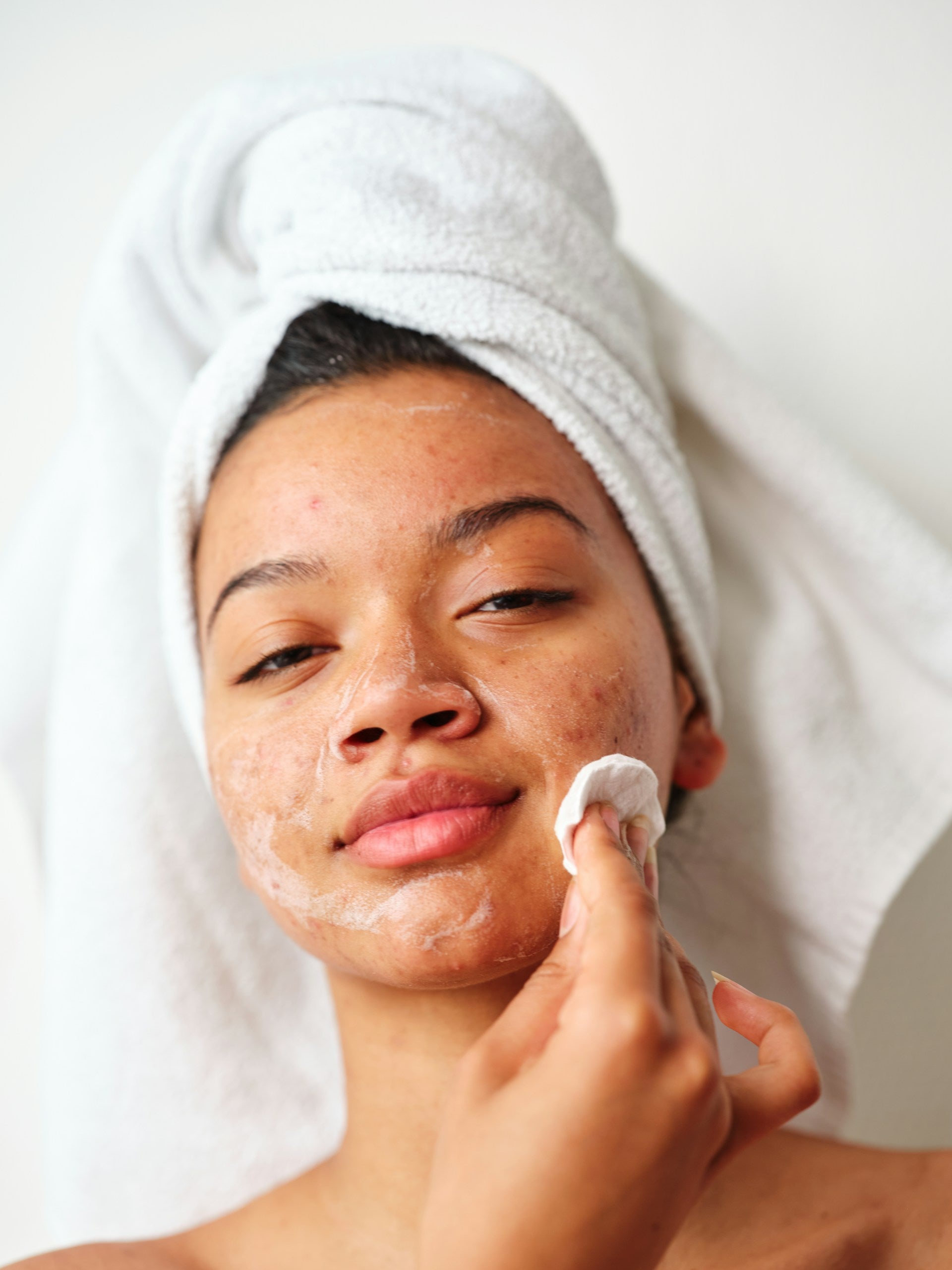 Acne Treatment