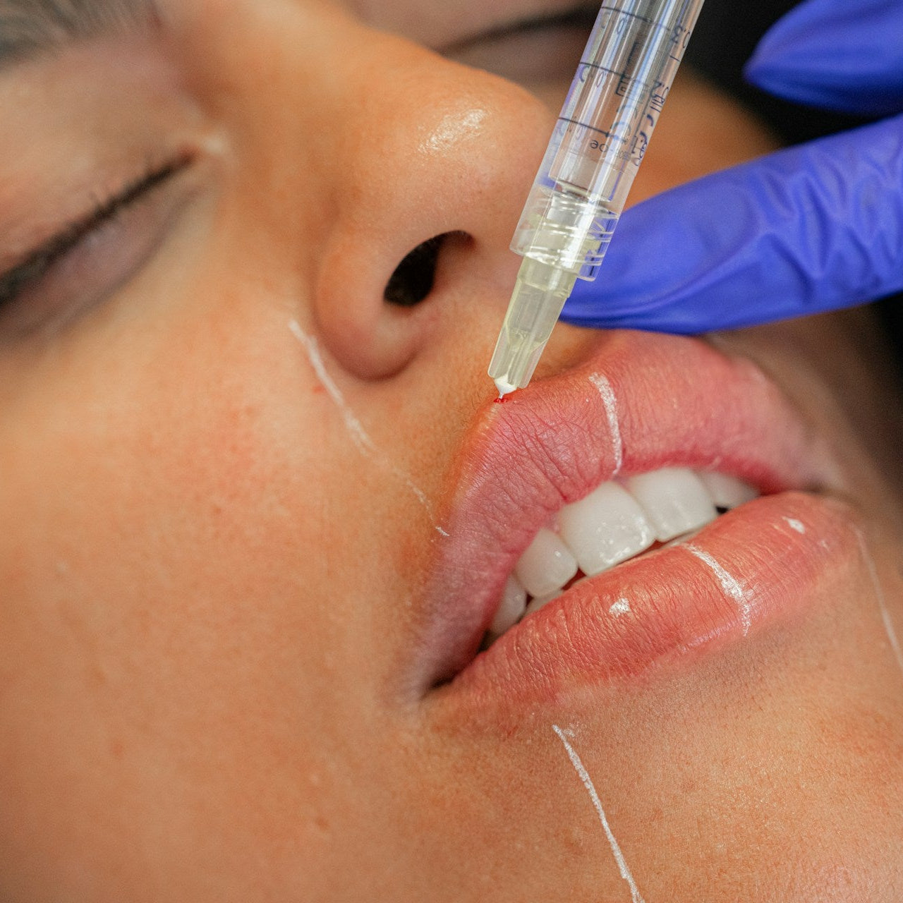 Dissolving Filler Treatment Image 3