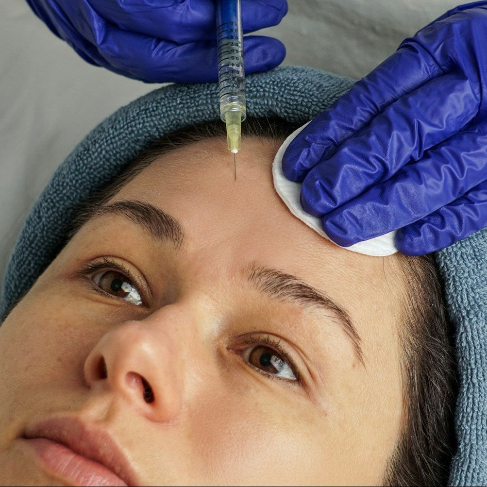 Ellanse Collagen Stimulant treatment Image 3