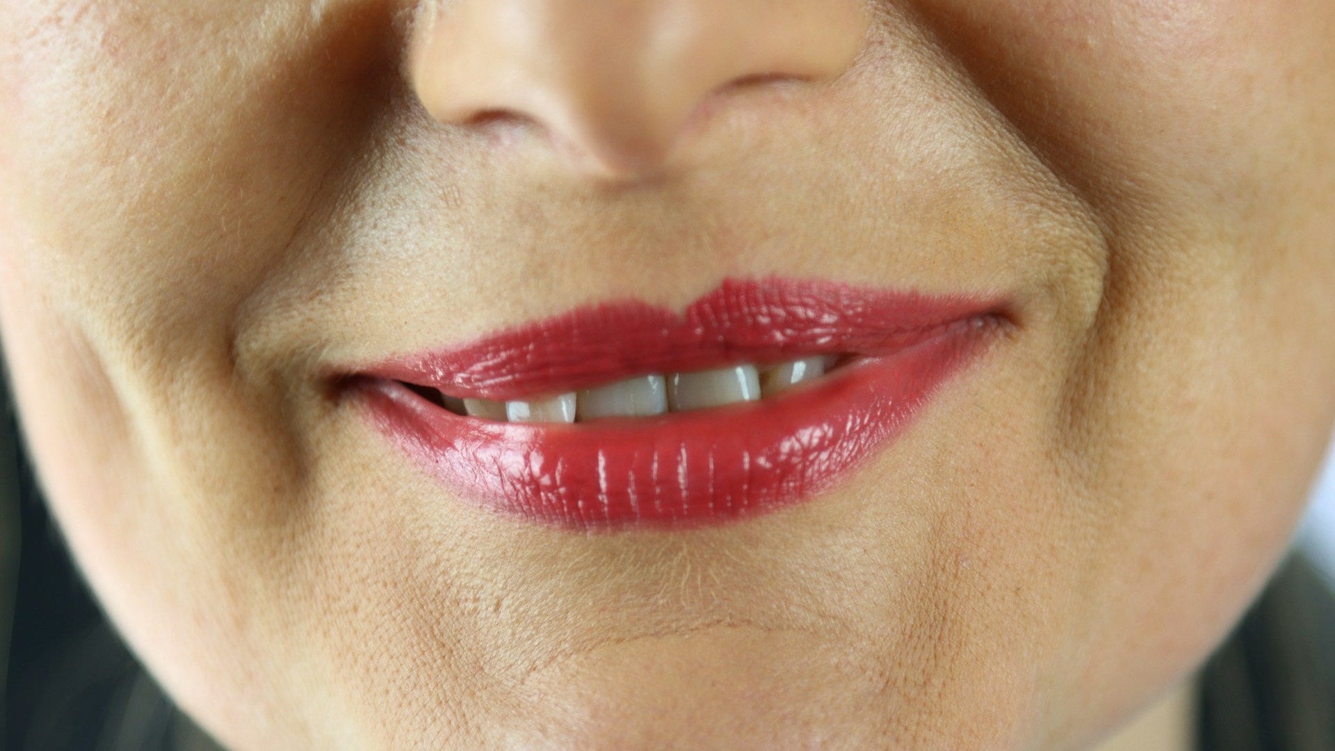Lip Volume Loss Concern