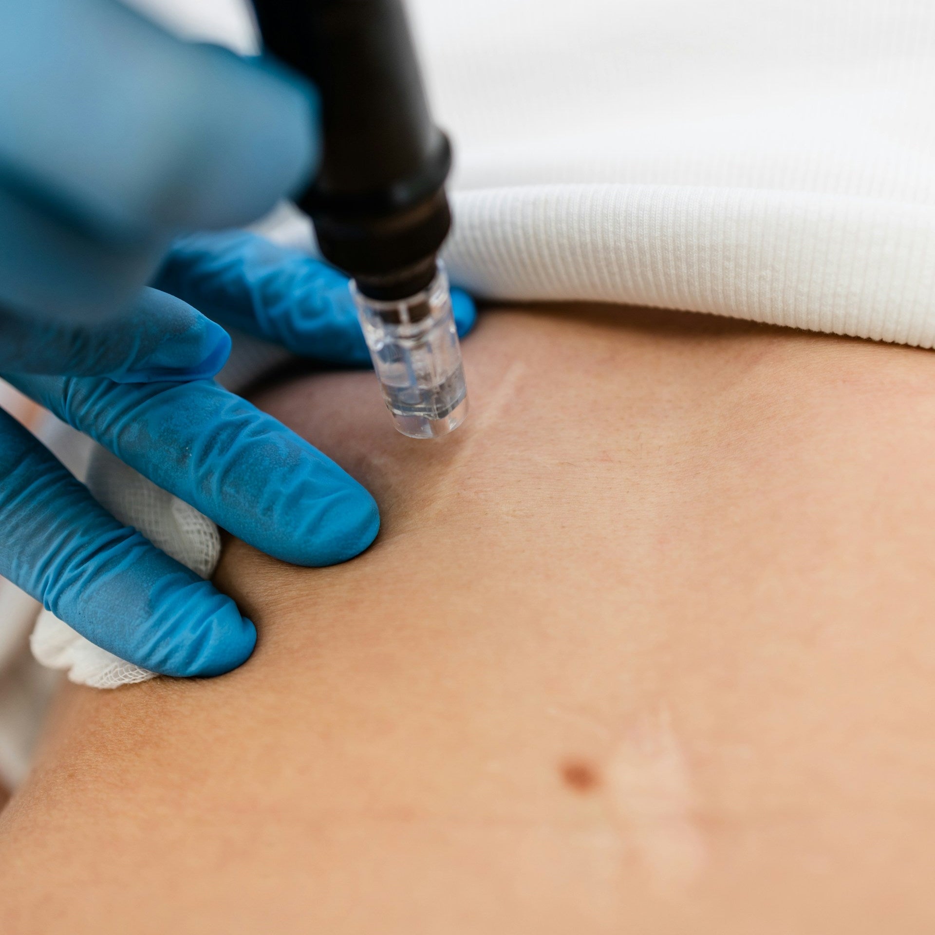 Microneedling Treatment Image 3