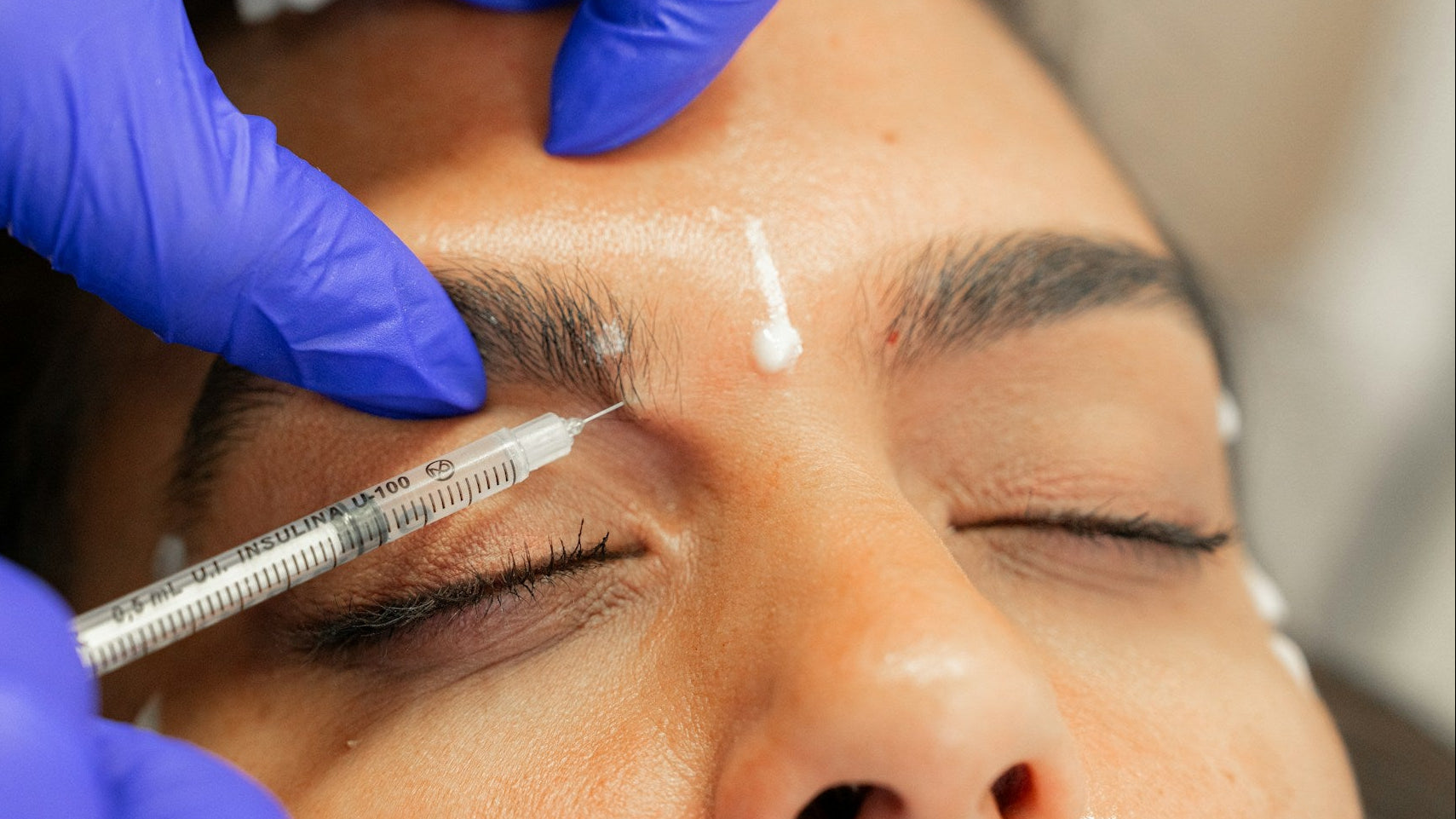 Non Surgical Brow Lift Treatment