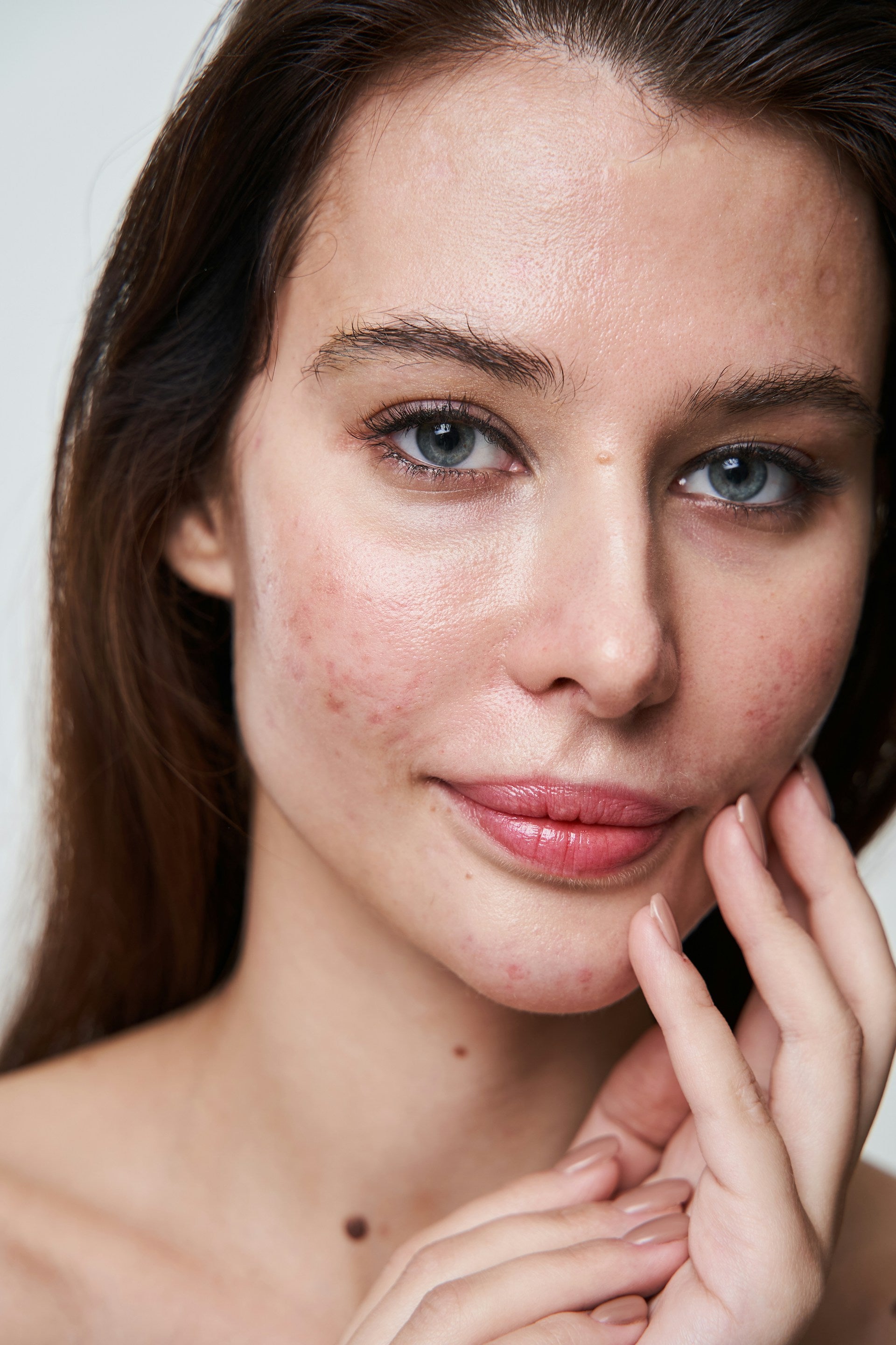Rosacea Redness Concerns