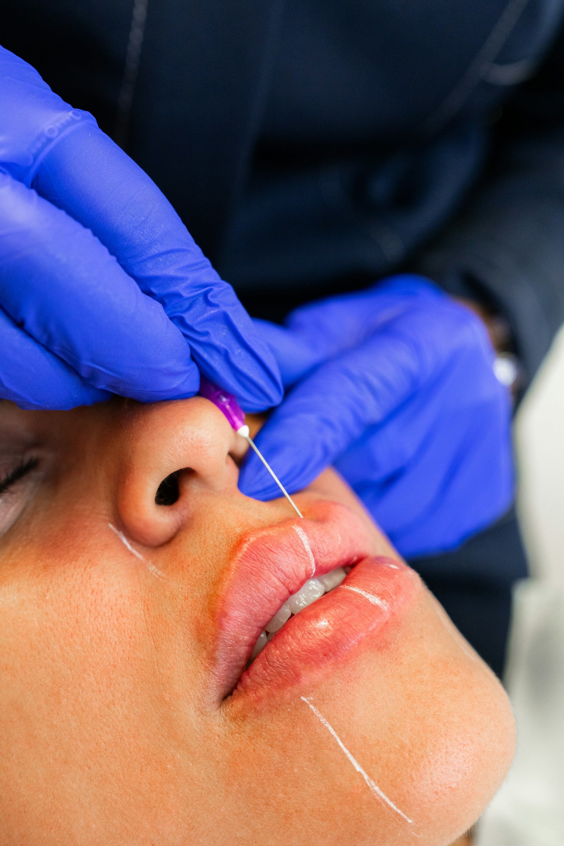 lip filler treatment