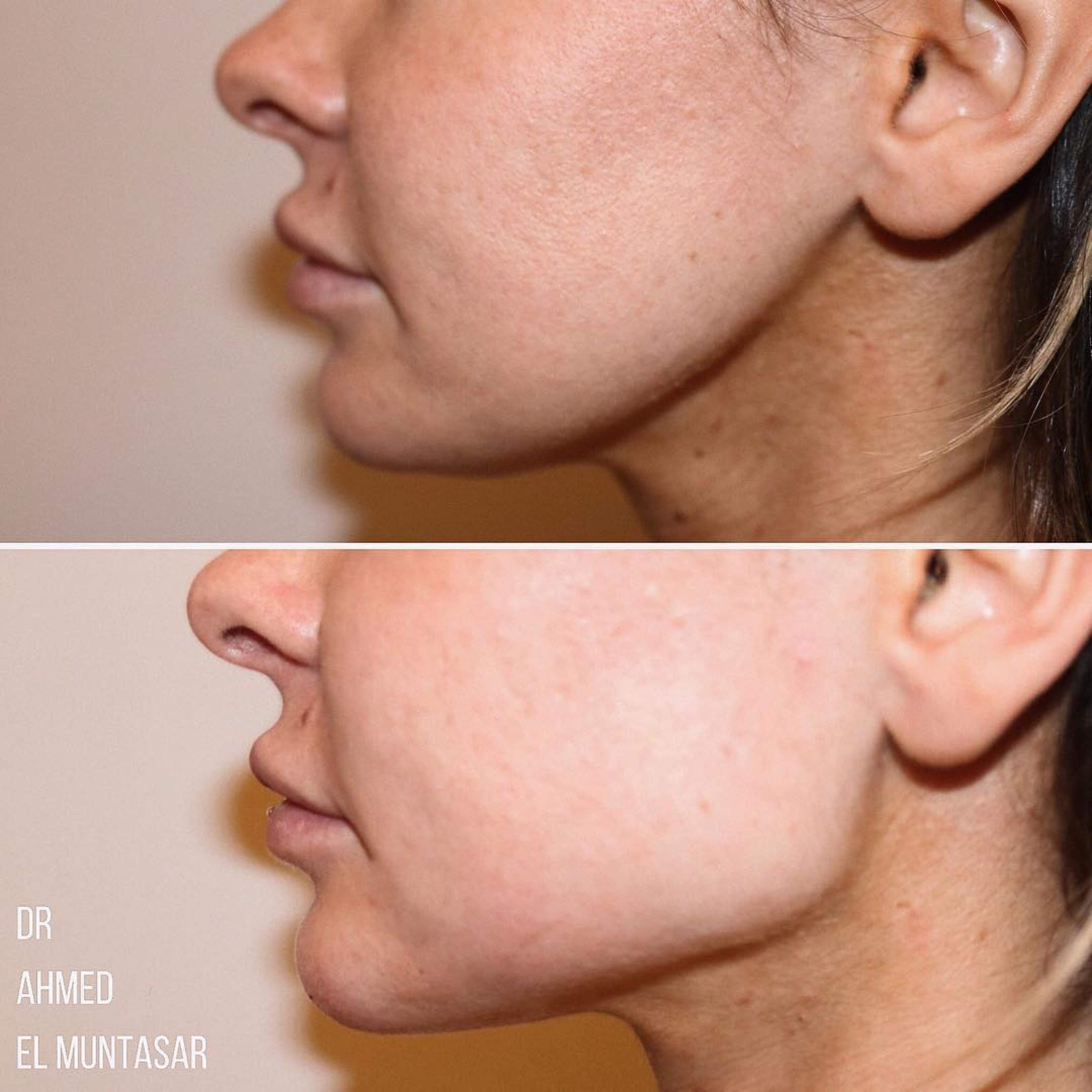 This image displays a split comparison of two profile views of the same person, with the top image labeled as "before" and the bottom as "after". The treatment performed was Jawline Filler treatment.