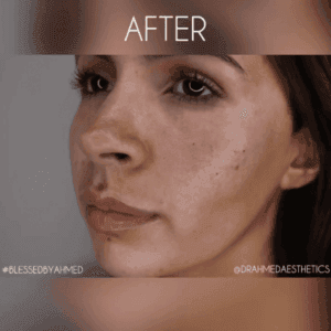 after cheek enhancement