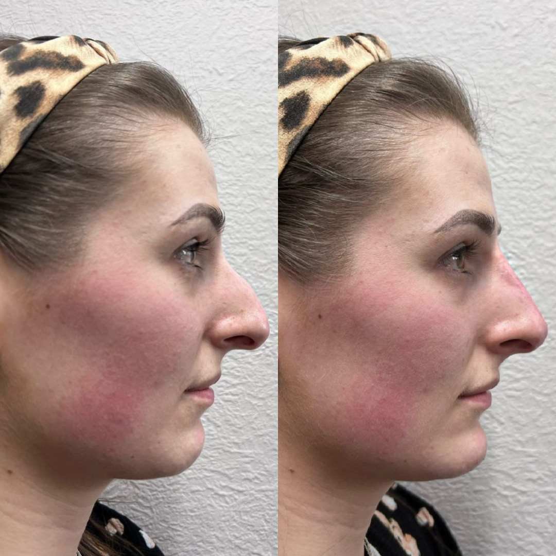 Non Surgical Rhinoplasty In Westminster The Aesthetics Doctor 