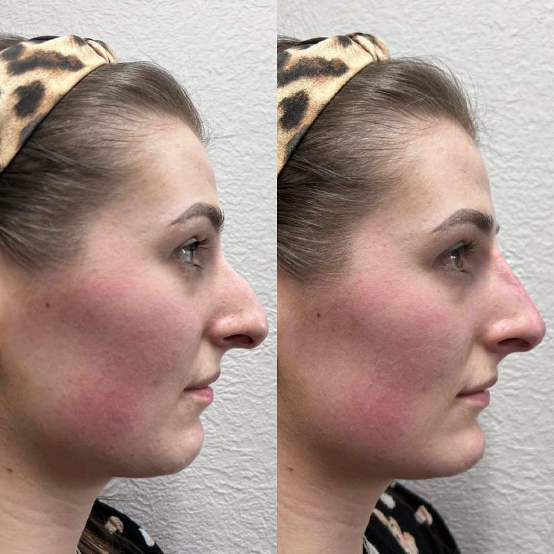 before and after (nose)