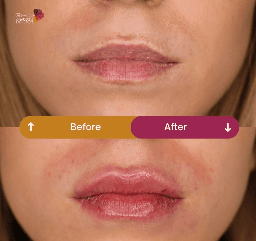  Lip Fillers Leeds