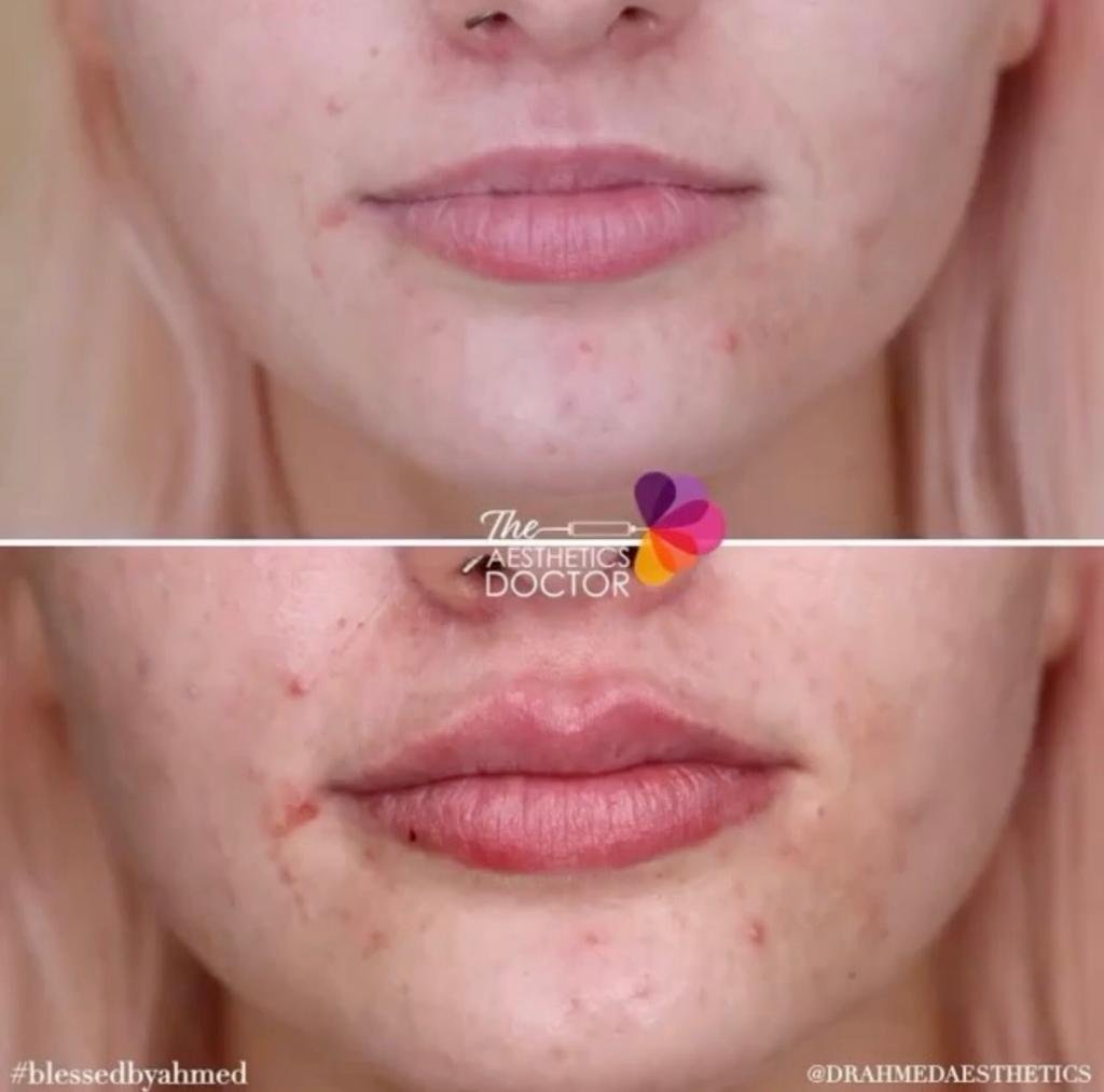 LIP FILLERS BEFORE AND AFTER