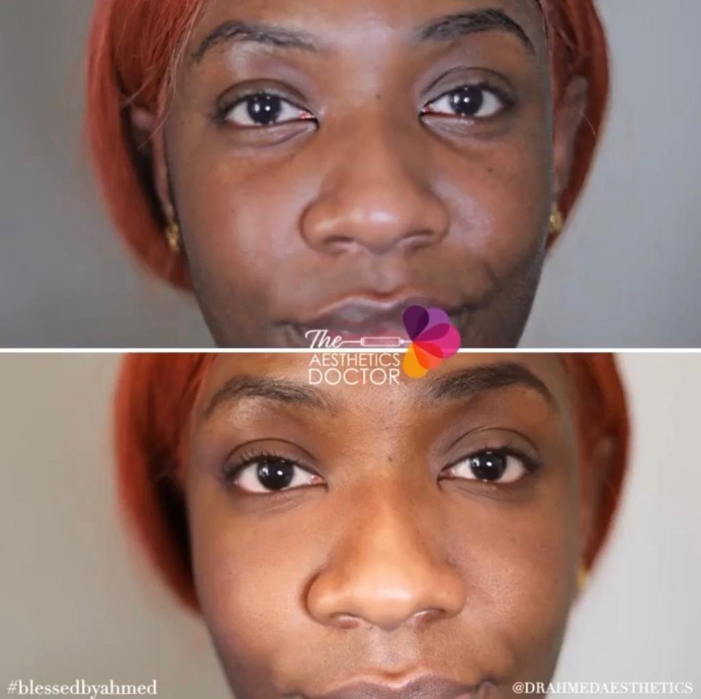 Before and after of a woman having now received tear trough filler treatment