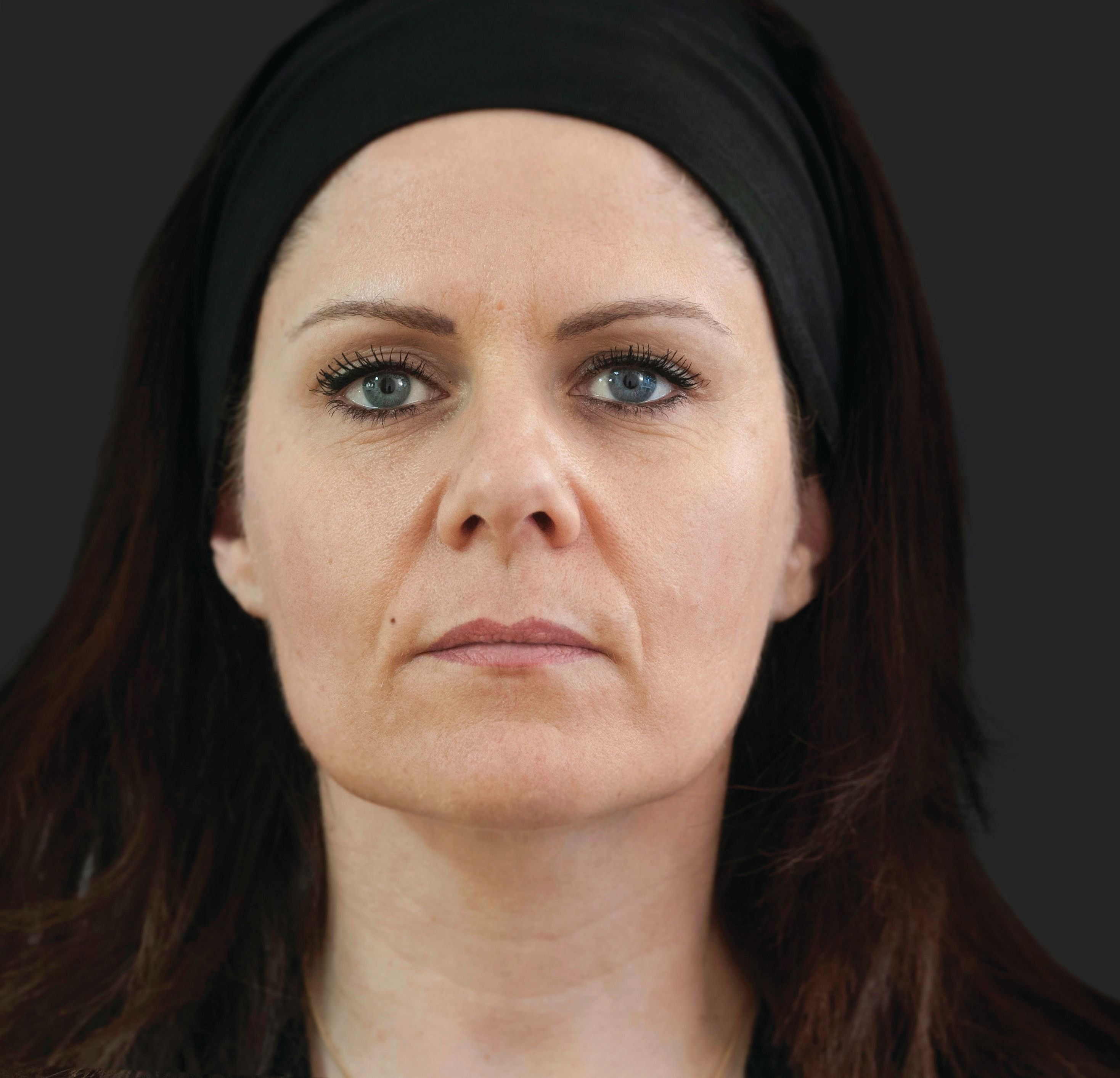 AFTER ELLANSE TREATMENT
