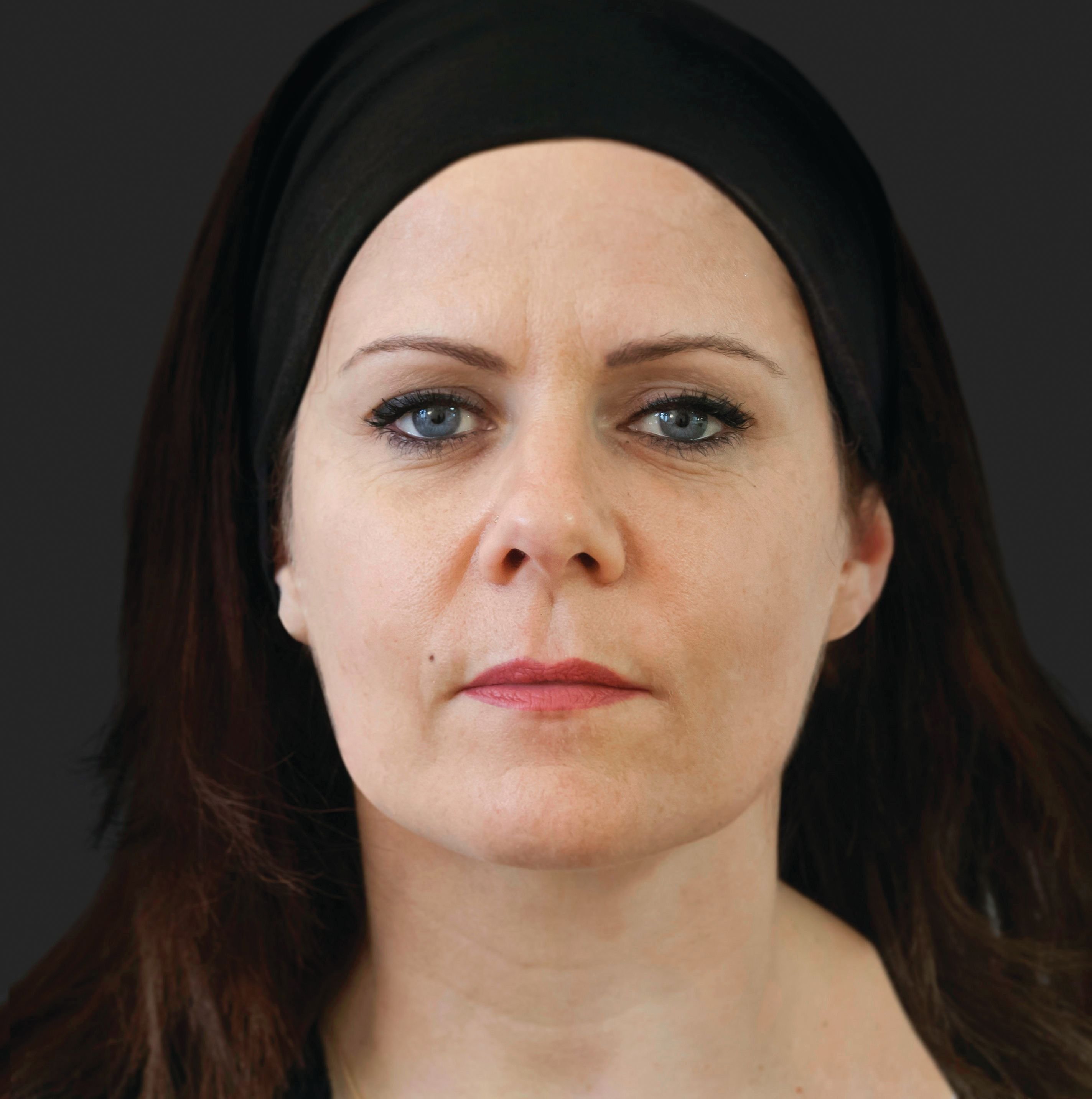 BEFORE ELLANSE TREATMENT