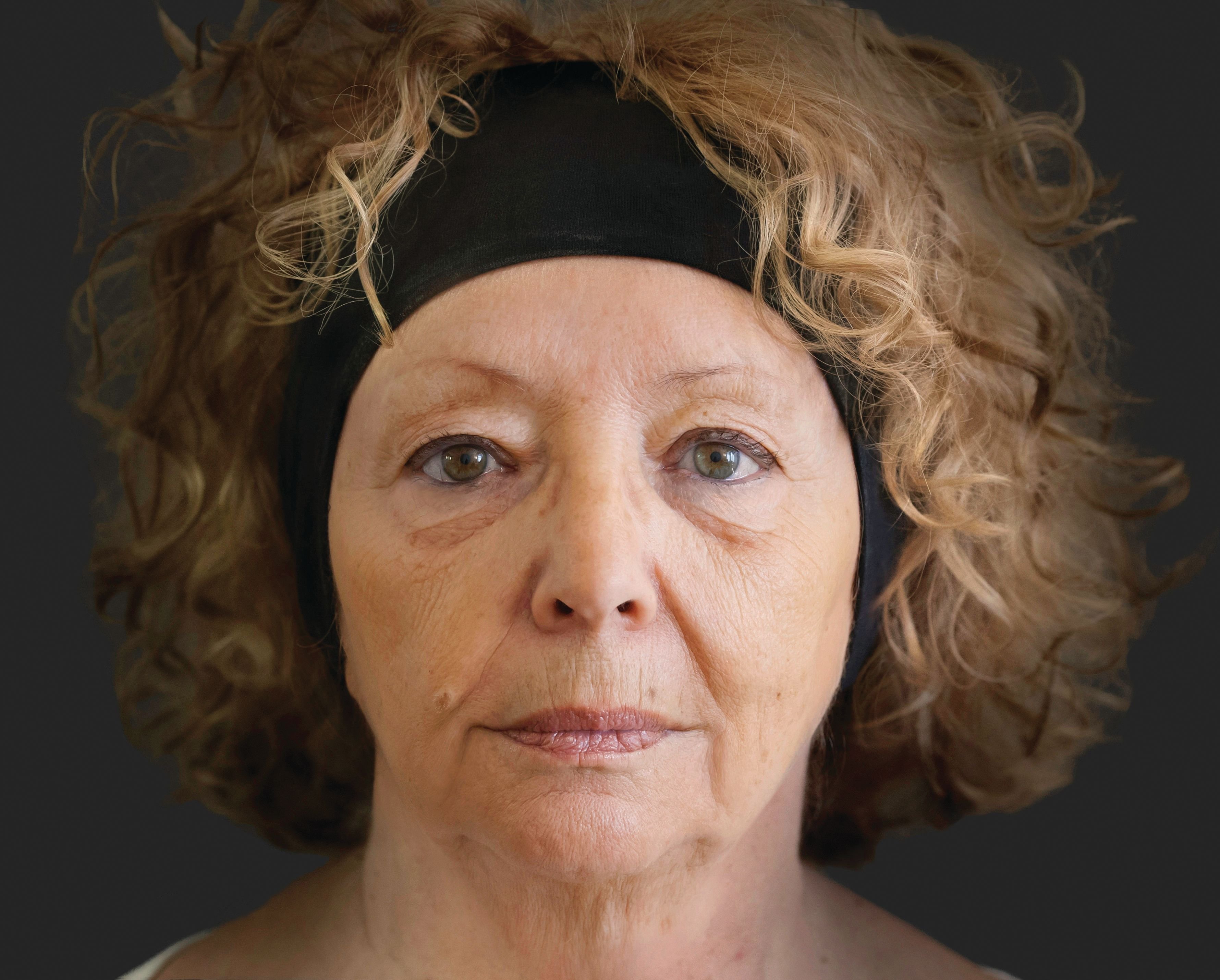 AFTER ELLANSE TREATMENT