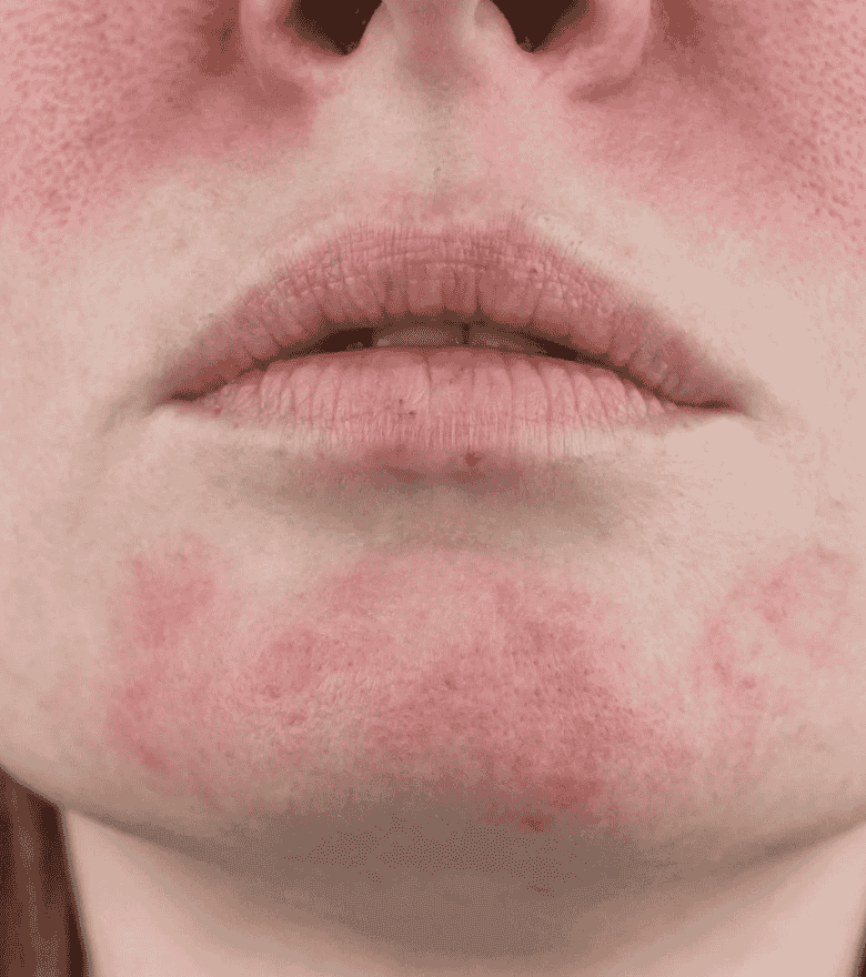 Rosacea