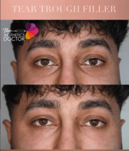 Tear Trough Filler Before and after