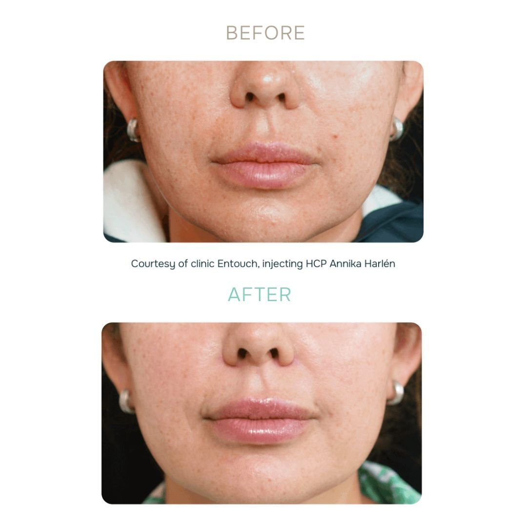 Julaine Injectable Before and After