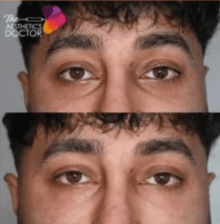 tear trough fillers