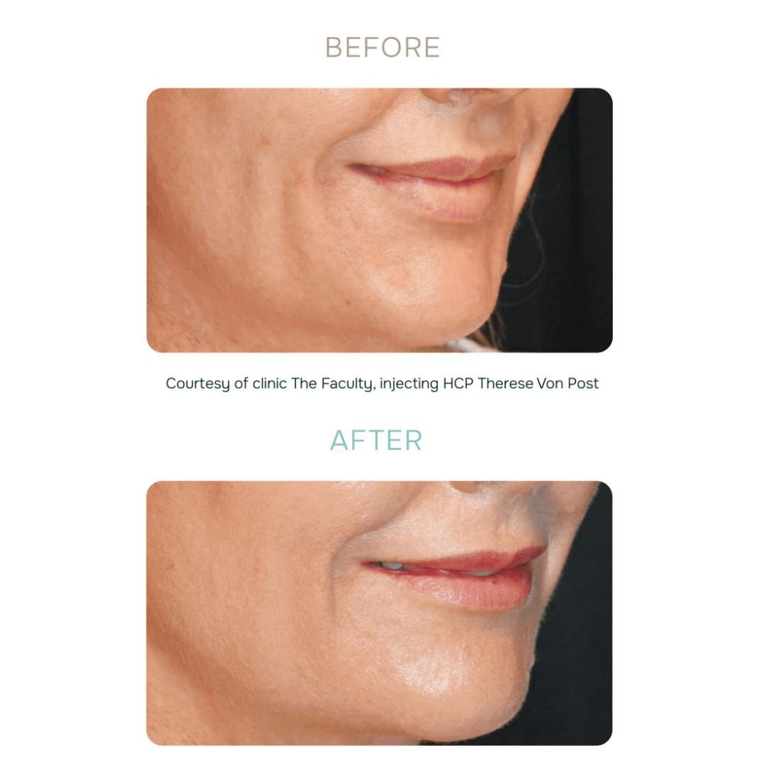 Julaine Injectable Before and After