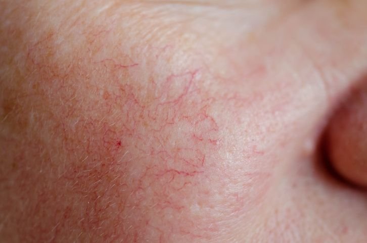 Vascular Lesions