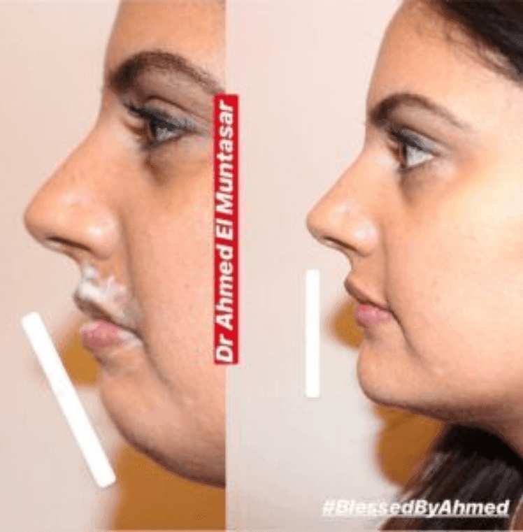 chin augmentation b/a