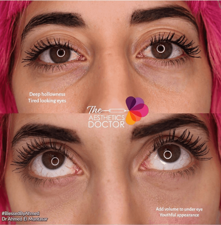before and after under eye hollows