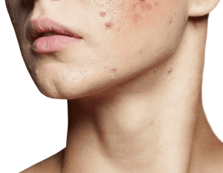 acne scar treatment
