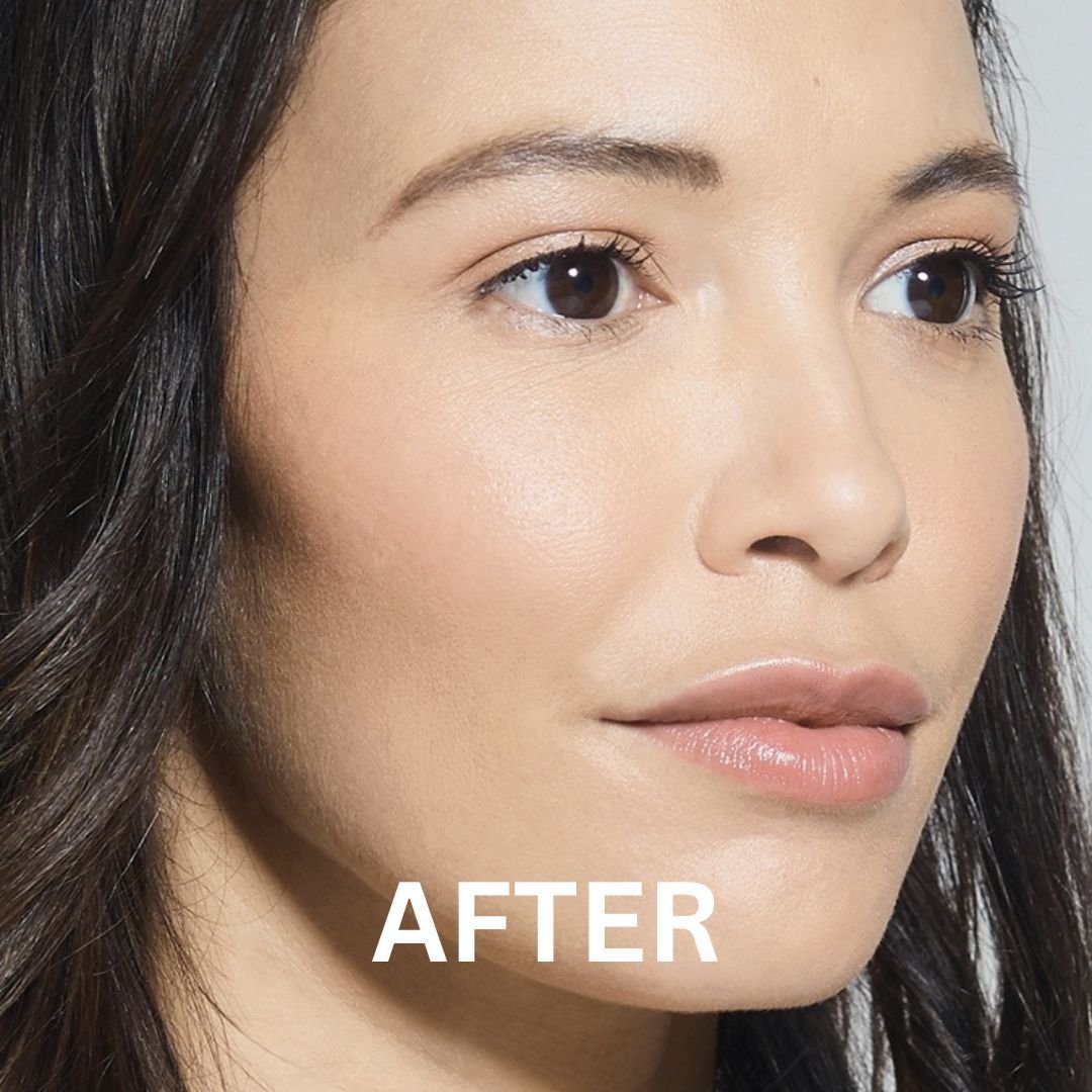 after nose job