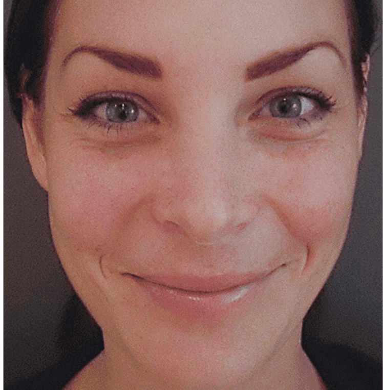 after chemical peel
