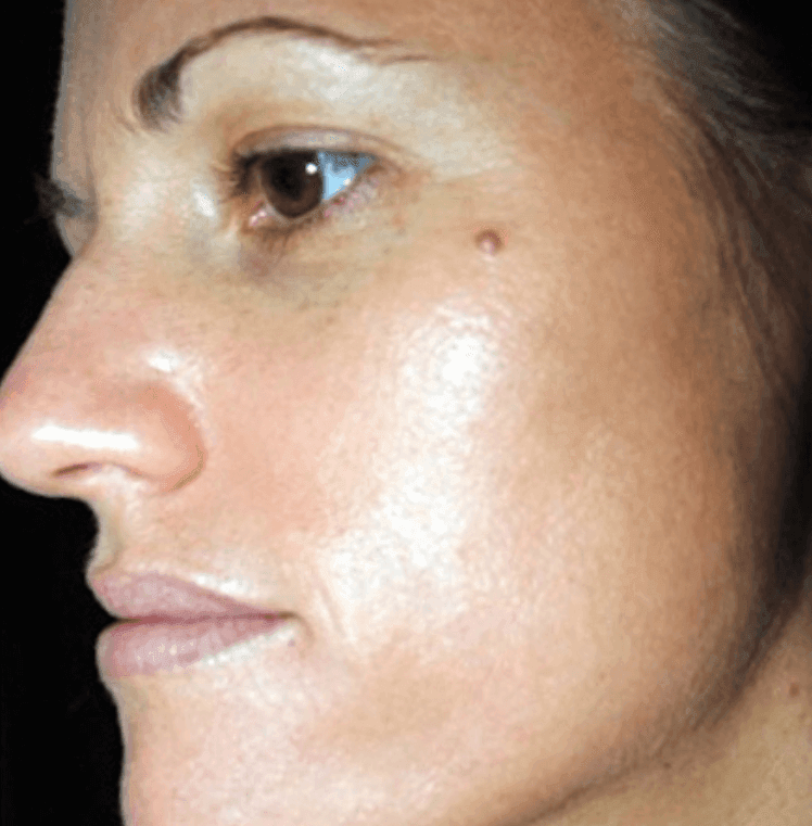 after chemical peel