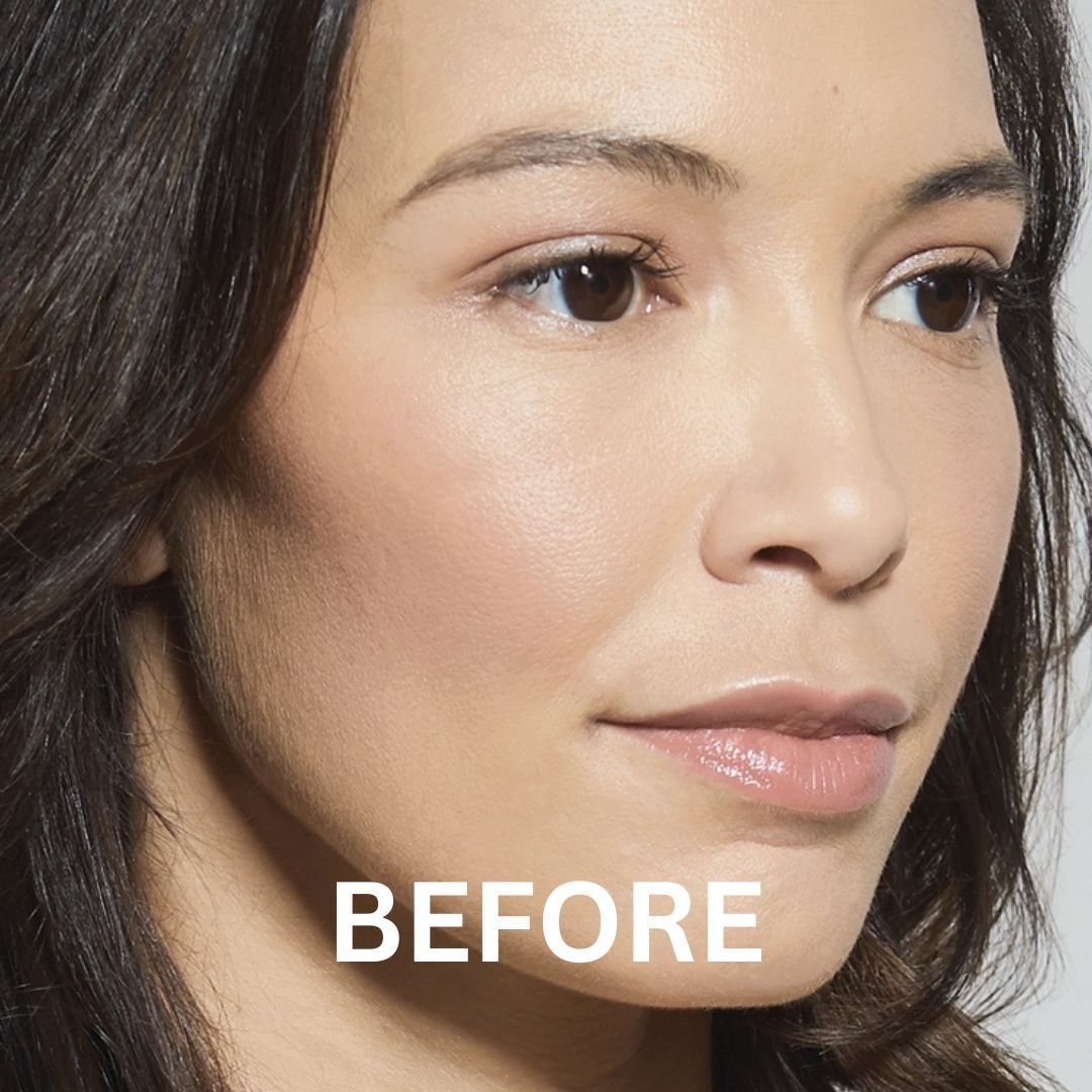 before nose job