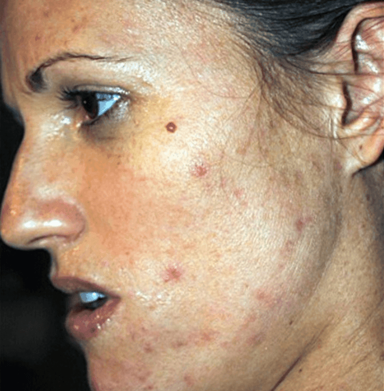 before chemical peel