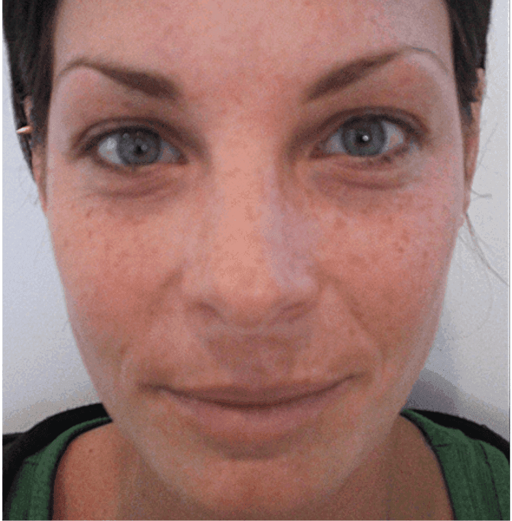 before chemical peel