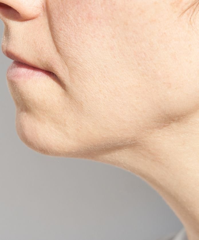 before jowls treatment