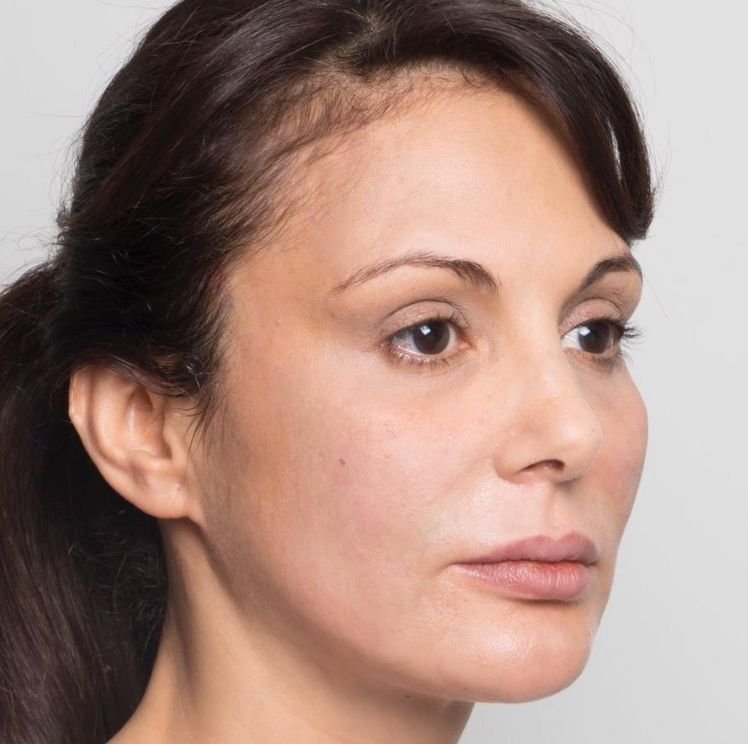 brow lift after