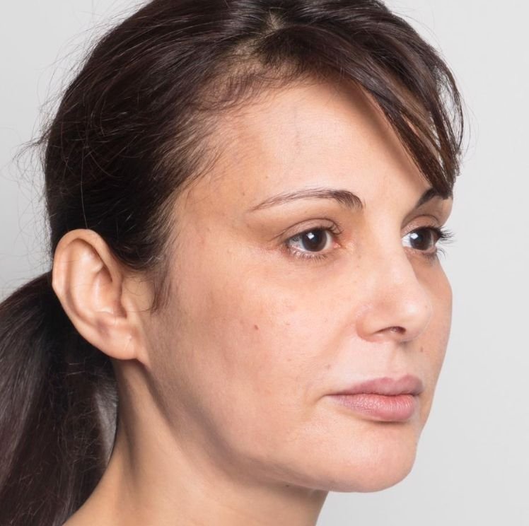 brow lift before