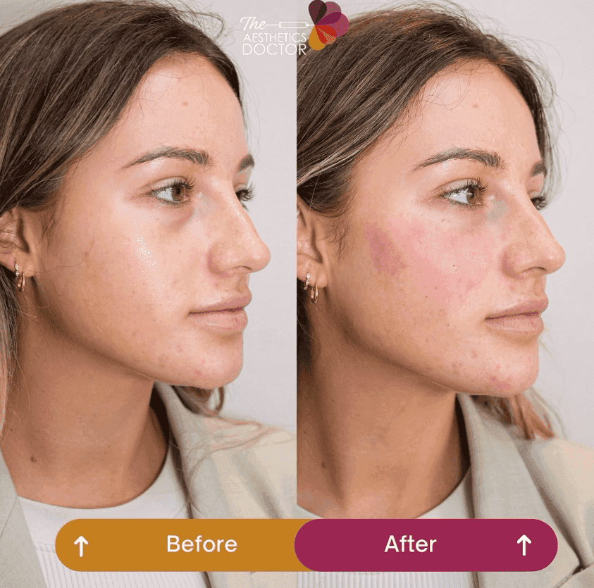 cheek fillers london
