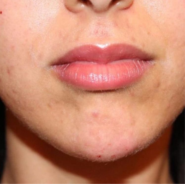 chin augmentation after