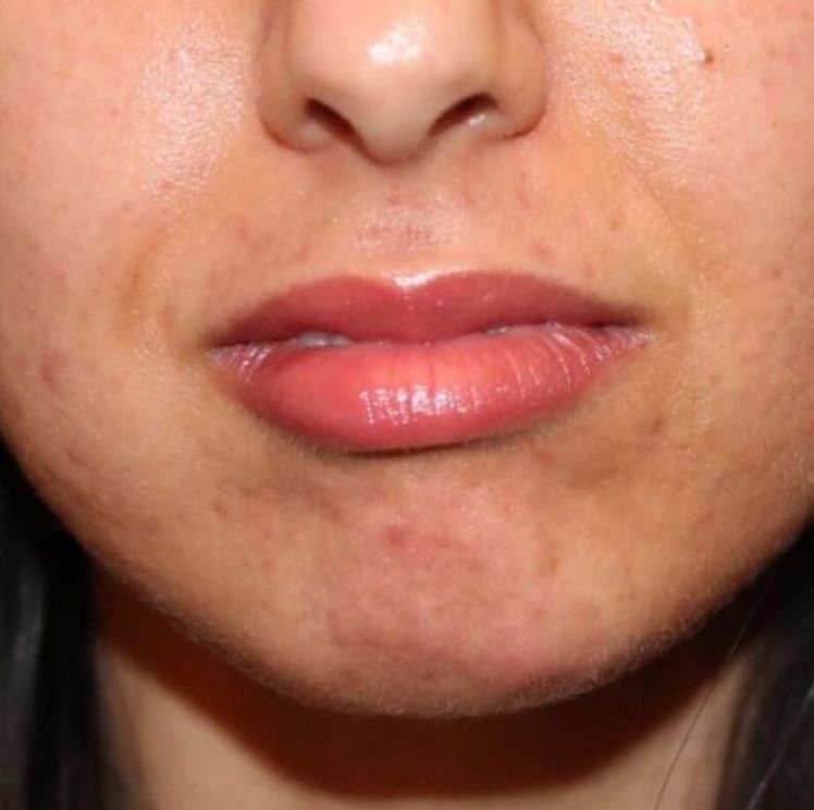 chin augmentation before