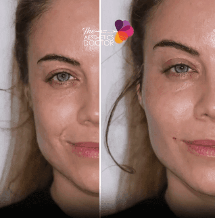 chin fillers leeds