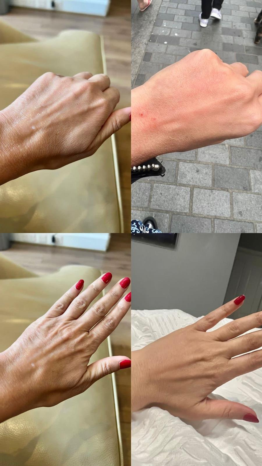 ellanse for hands
