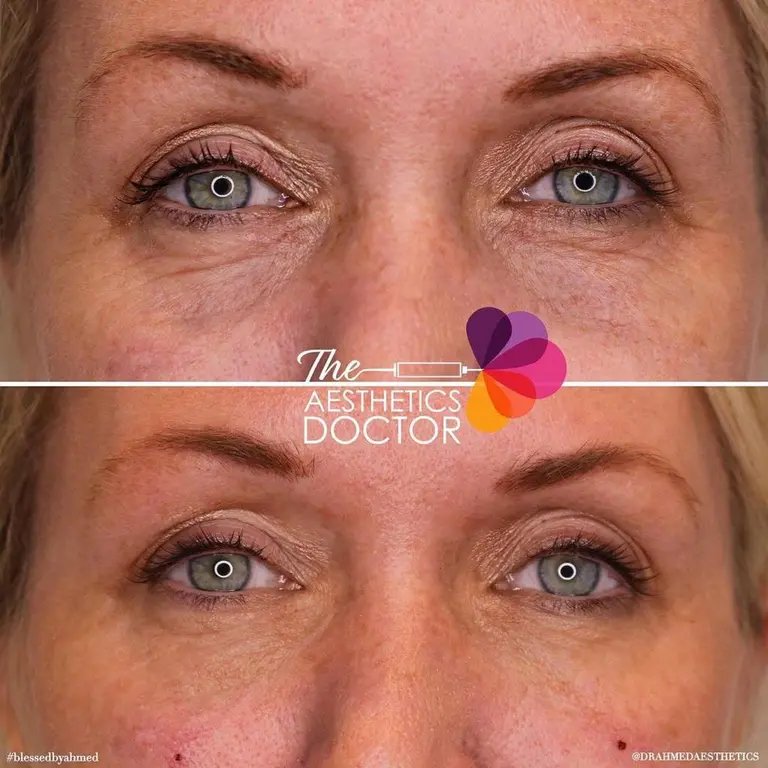 eyes before and after